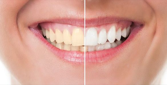 clareamento antes e depois
