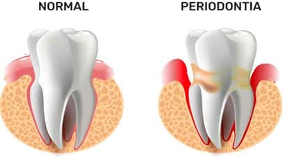 dente normal e periodontia