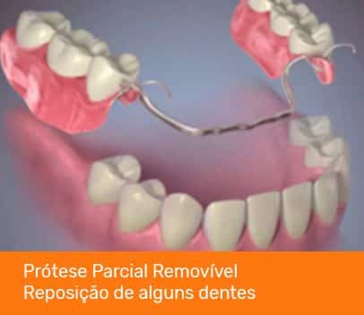 protese parcial removivel