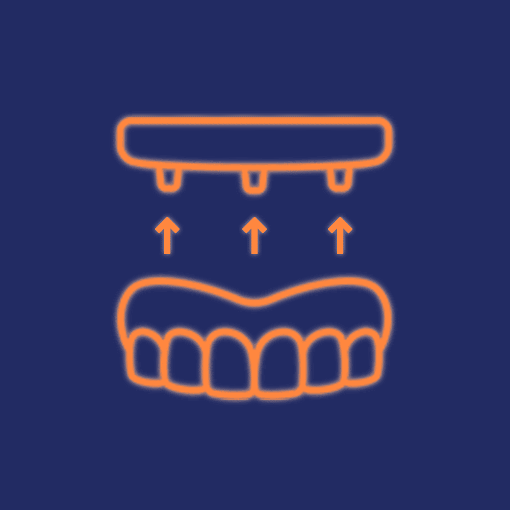 Para o paciente que perdeu todos os dentes de uma mesma arcada dentária, essa é uma solução segura e muito eficiente para a reabilitação oral.